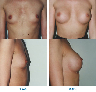Aumento del seno con cicatrice nel solco sotto mammario e posizionamento della protesi sotto la fascia muscolare.